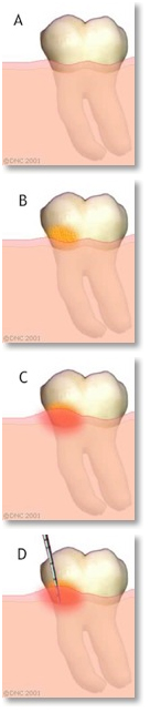 gingivitis