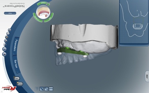 Software modelling shows bar, implants and denture (view 1). 