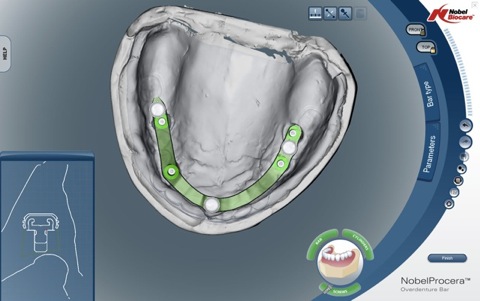 Software modelling shows bar, implants and denture (view 2). 