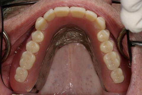 Denture inside the patient's mouth. Unlike a traditional denture, the open palate  enhances the enjoyment of food and decreases gagging.