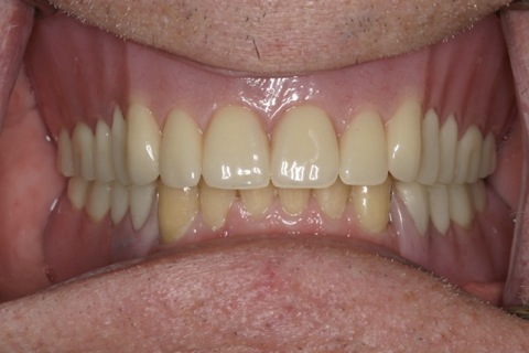 Post-treatment, including implant retained partial lower denture.