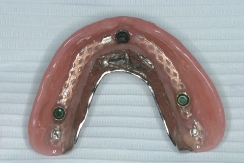 Final denture - inside surface