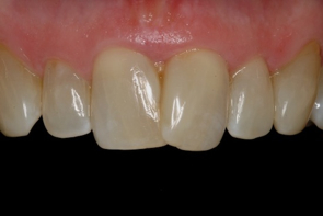 Dental Veneers