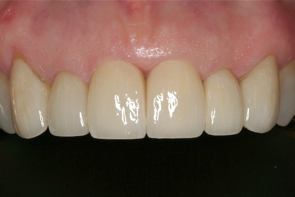 Dental Veneers