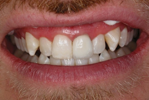 Dental Crowns Pre and Post Photos