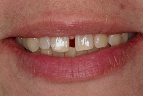 Dental Veneers