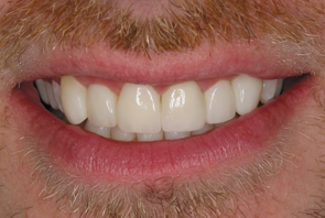 Dental Crowns Pre and Post Photos