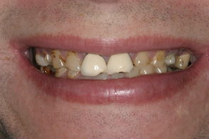 Implant Dentistry Before and After Photos