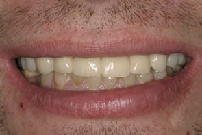 Implant Dentistry Before and After Photos