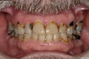 Dental Decay Treatment by Dr Richard Burns