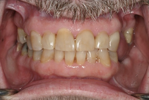 Dental Decay Treatment by Dr Richard Burns