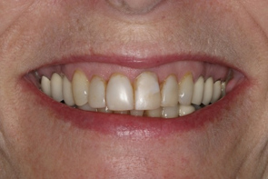 Dental Crowns Pre and Post Photos