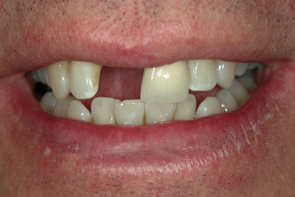 Implant Dentistry Before and After Photos