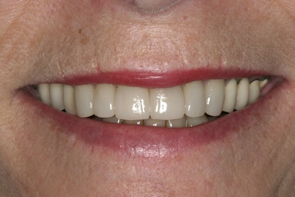 Dental Crowns Pre and Post Photos