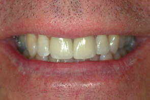 Implant Dentistry Before and After Photos