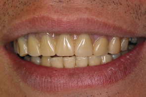 Implant Dentistry Before and After Photos