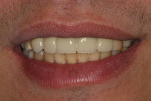 Implant Dentistry Before and After Photos