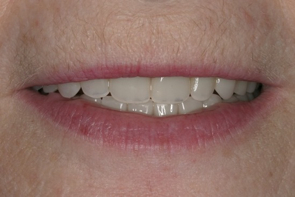 Implant Dentistry Before and After Photos